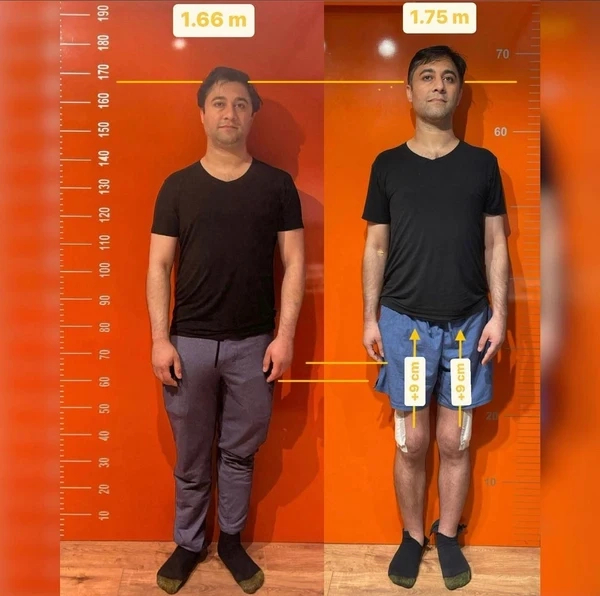 Height increase result 1
