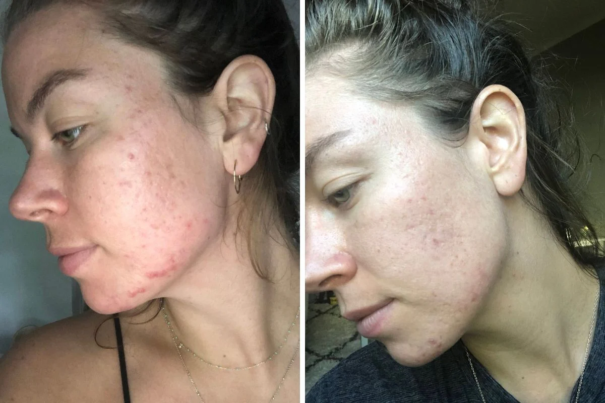Skin 1