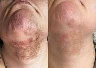 Skin 3